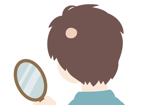 抜け毛の原因究明：円形脱毛症かAGAか、正確な見分け方と専門医の重要性