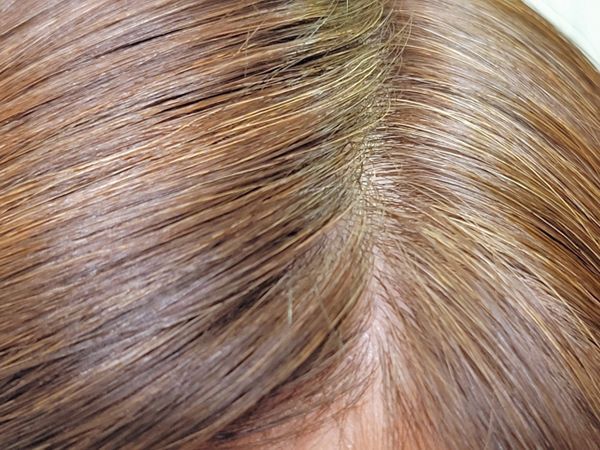 白髪を防ぐ最良の方法：科学的根拠に基づく効果的な対策とライフスタイルの改善